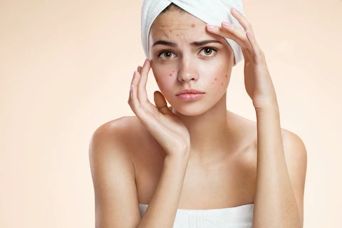 Say goodbye to acne once and for all with M.A.D Skincare’s expert guidance